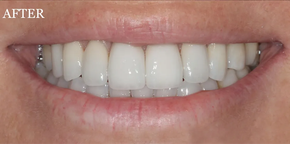 Porcelain veneers after treatment