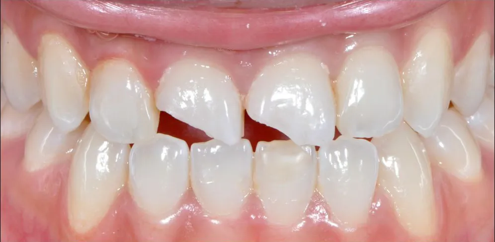 Cosmetic Bonding