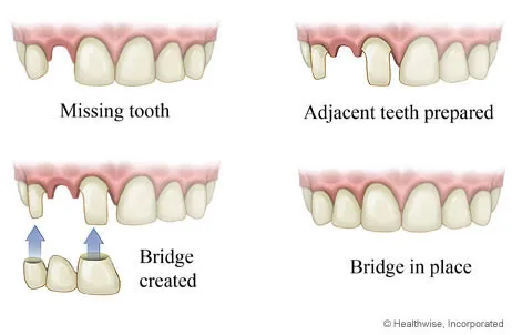 Tooth-Coloured Fillings