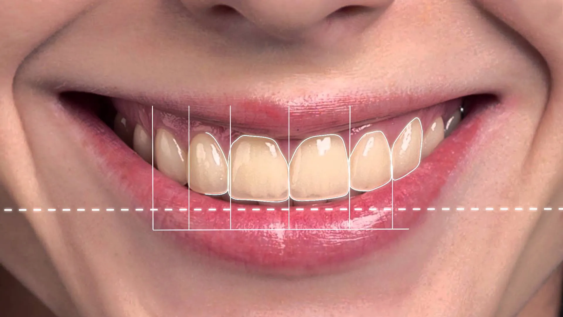 Tooth-Coloured Fillings