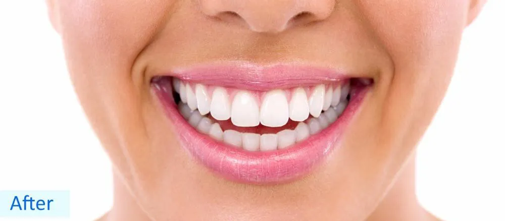 Teeth whitening after treatment