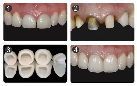 Porcelain crown treatment result