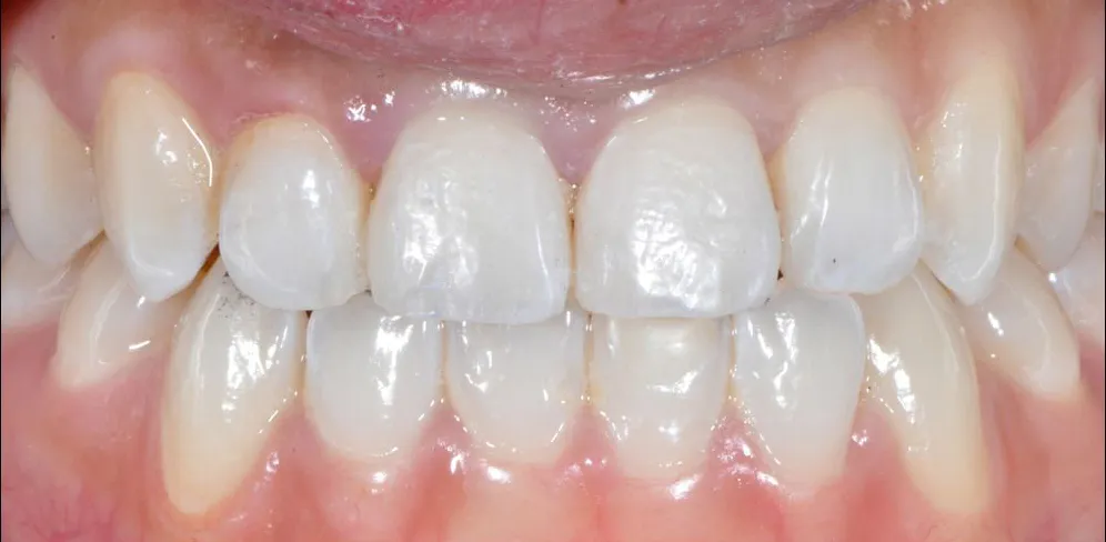 Cosmetic Bonding