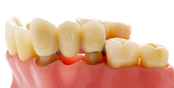 Tooth-Coloured Fillings