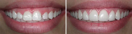 Tooth-Coloured Fillings