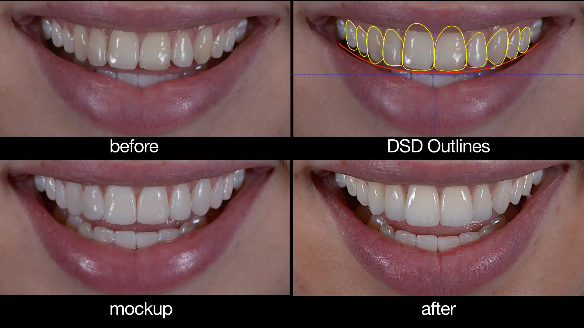 Tooth-Coloured Fillings