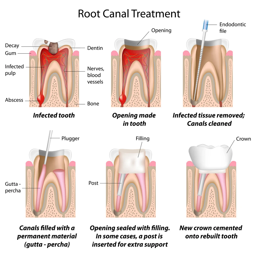 Root canal treatment procedure diagram