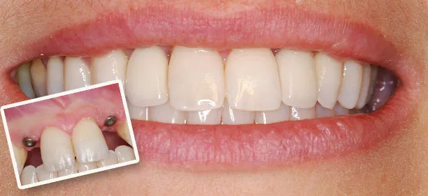 Dental implant result