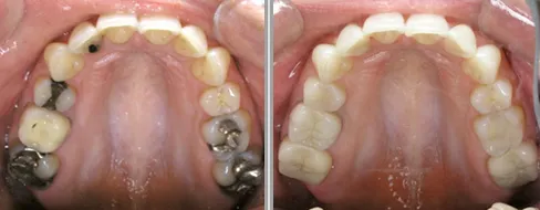 Dental inlays and onlays