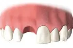 Dental implant placed into the jawbone