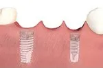 Dental implant placed into the jawbone