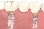 Porcelain crown fitted to the dental implant