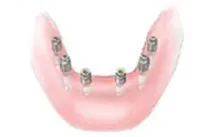 Dental implants used to support a denture
