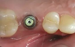Dental implant before final restoration