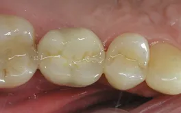 Dental implant after final crown restoration