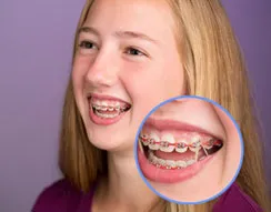 Patient using orthodontic elastics