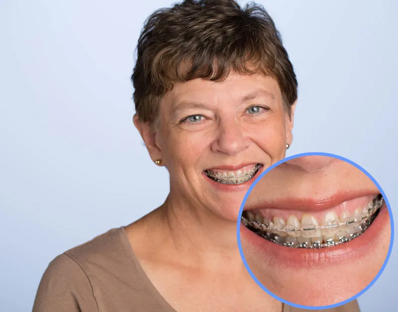 Traditional ceramic braces