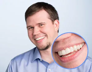 Patient using clear aligners