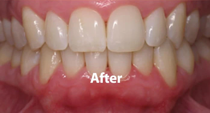 Gums after periodontal treatment